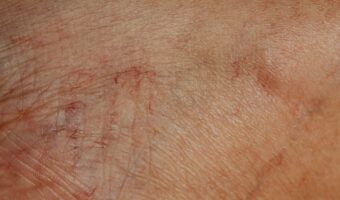 White Spots on the Skin After Age 50: 8 Hidden Causes to Watch For
